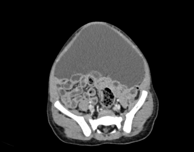Abdominal premesenteric cystic lymphangioma (Radiopaedia 82995-97350 Axial C+ portal venous phase 50).jpg