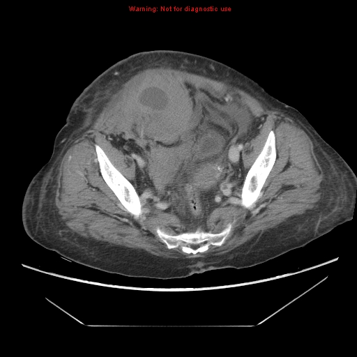 File:Abdominal wall hematoma (Radiopaedia 9427-10112 Axial C+ portal venous phase 90).jpg