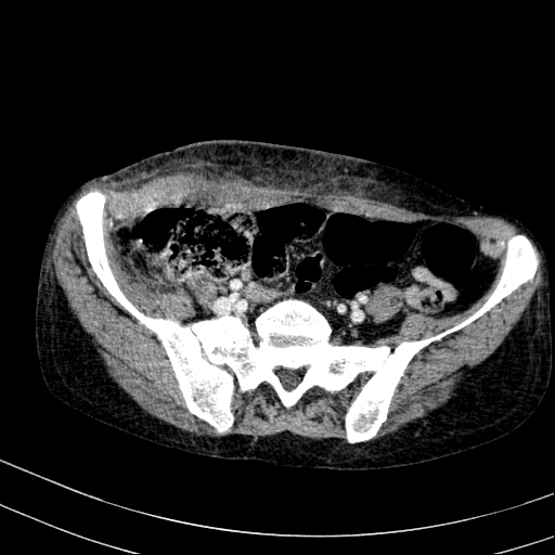Abdominal wall hematoma with active bleeding (Radiopaedia 83915-99117 Axial C+ portal venous phase 96).jpg
