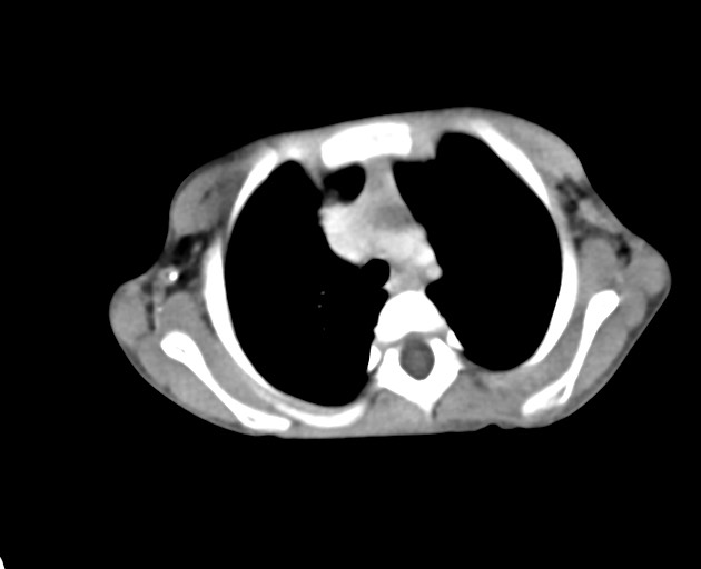 Abdominopelvic rhabdomyosarcoma (Radiopaedia 78356-90984 Axial C+ portal venous phase 9).jpg