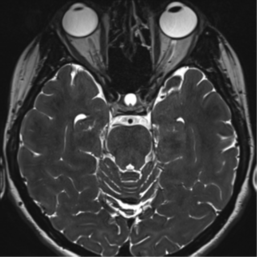 Abducens nerve palsy (Radiopaedia 51069-56648 Axial T2 fat sat 54).png