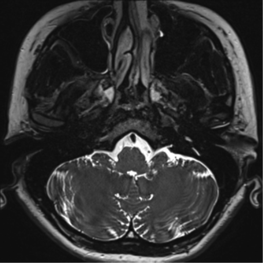 Abducens nerve palsy (Radiopaedia 51069-56648 Axial T2 fat sat 6).png