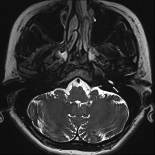 File:Abducens nerve palsy (Radiopaedia 51069-56648 Axial T2 fat sat 7).png
