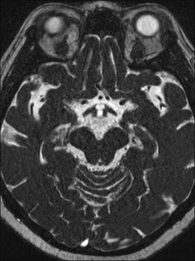 Abducens nerve palsy (Radiopaedia 57084-63976 Axial T2 ciss 3d 56).jpg