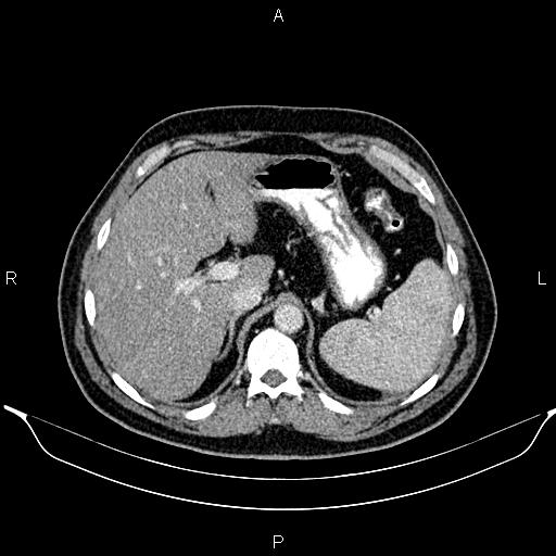 File:Aberrant right subclavian artery (Radiopaedia 87093-103354 Axial With contrast 114).jpg