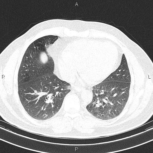 File:Aberrant right subclavian artery (Radiopaedia 87093-103354 Axial lung window 75).jpg