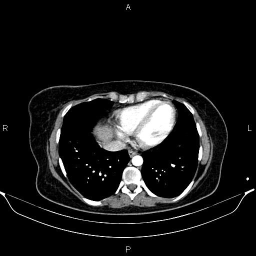 Aberrant right subclavian artery (Radiopaedia 87334-103629 Axial C+ arterial phase 47).jpg