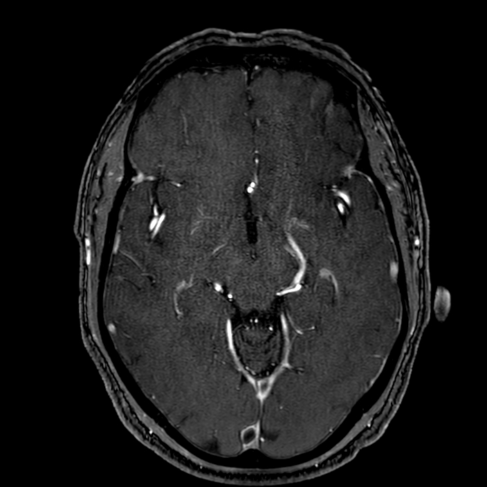 Accessory middle cerebral artery (Radiopaedia 73114-83828 Axial MRA 84).jpg