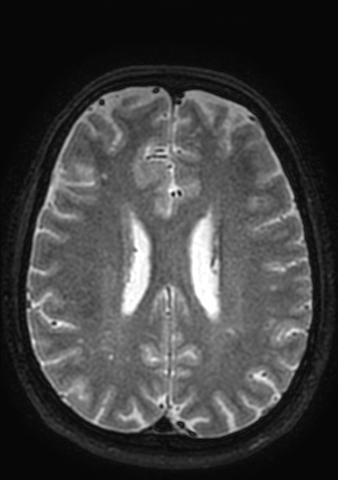 Accessory middle cerebral artery (Radiopaedia 73114-83828 Axial T2 19).jpg