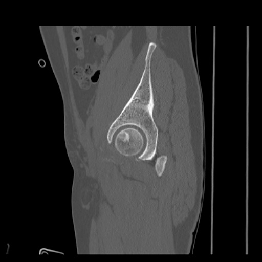 File:Acetabular and ilial fractures (Radiopaedia 59084-66378 Sagittal bone window 28).jpg