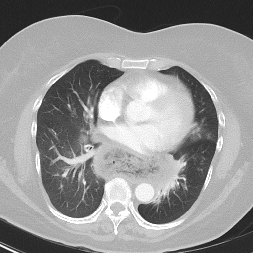 File:Achalasia (Radiopaedia 47147-51685 Axial lung window 29).png