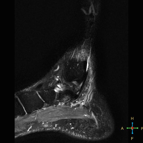 File:Achilles tendon complete tear (Radiopaedia 22834-22854 Sagittal STIR 15).jpg
