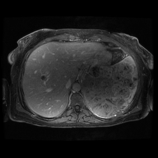 Acinar cell carcinoma of the pancreas (Radiopaedia 75442-86668 Axial T1 C+ fat sat 108).jpg
