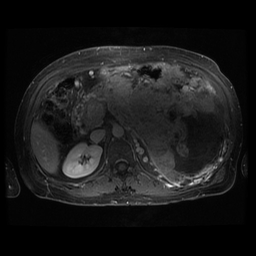 Acinar cell carcinoma of the pancreas (Radiopaedia 75442-86668 Axial T1 C+ fat sat 60).jpg