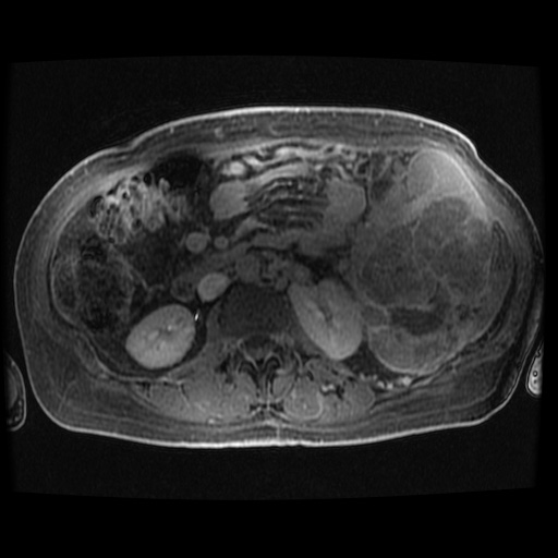 File:Acinar cell carcinoma of the pancreas (Radiopaedia 75442-86668 Axial late phase (~30 mins) 32).jpg