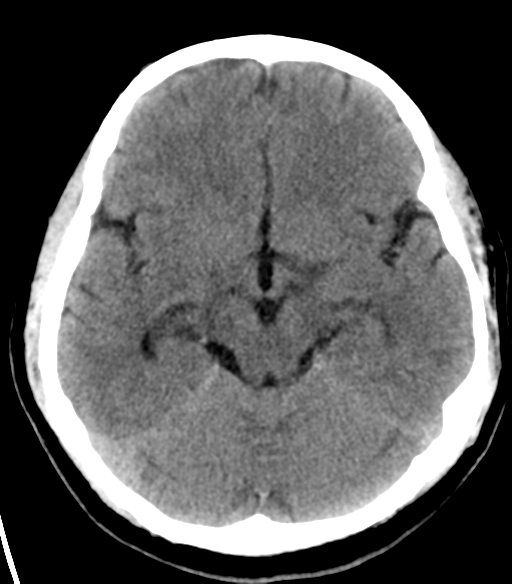 File:Acoustic schwannoma (Radiopaedia 33045-34065 Axial non-contrast 10).png
