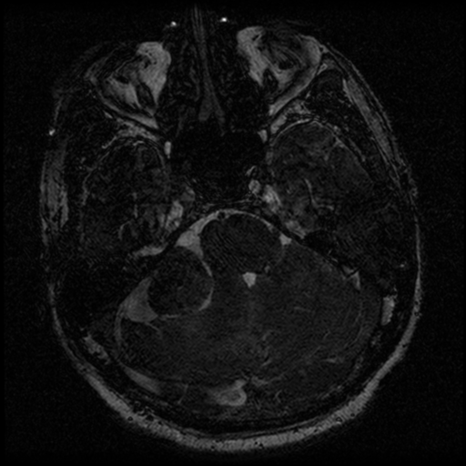 File:Acoustic schwannoma (Radiopaedia 39170-41387 Axial FIESTA 80).png