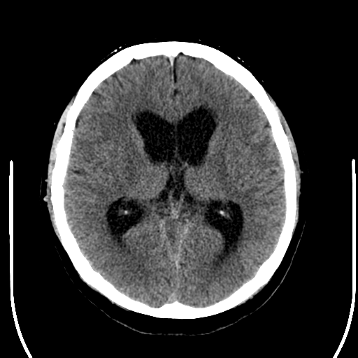 File:Acoustic schwannoma (Radiopaedia 39170-41389 Axial non-contrast 15).png