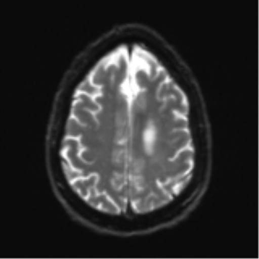 Acoustic schwannoma (Radiopaedia 55729-62281 E 22).png