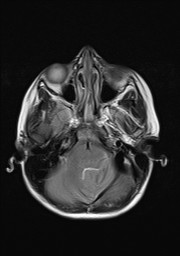 File:Acquired cerebellar tonsillar ectopia (Radiopaedia 39950-42423 Axial T2 4).jpg