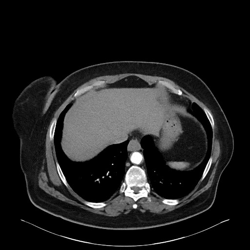 Acromioclavicular joint cyst (Radiopaedia 58455-65610 Axial C+ arterial phase 82).jpg