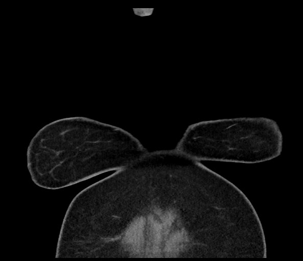 Acromioclavicular joint cyst (Radiopaedia 58455-65610 Coronal C+ arterial phase 14).jpg