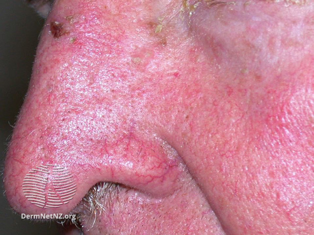 Actinic Keratoses affecting the face (DermNet NZ lesions-ak-face-515).jpg