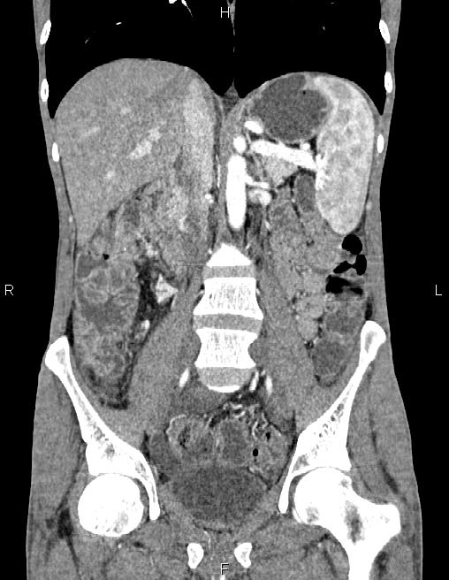 Active crohn disease (Radiopaedia 87133-103397 Coronal C+ arterial phase 35).jpg