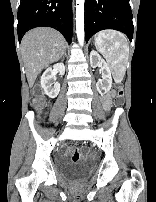 Active crohn disease (Radiopaedia 87133-103397 Coronal C+ arterial phase 42).jpg