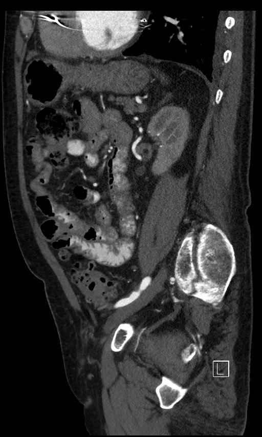 Active lower gastrointestinal bleeding - diverticular (Radiopaedia 61203-69106 Sagittal C+ arterial phase 56).jpg