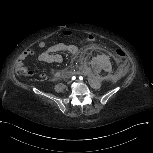 Active renal extravasation with large subcapsular and retroperitoneal hemorrhage (Radiopaedia 60975-68796 Axial C+ arterial phase 123).jpg