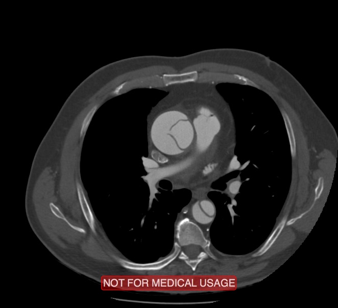 Acute aortic dissection - Stanford type A (Radiopaedia 40661-43285 Axial C+ arterial phase 28).jpg