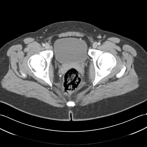 Acute appendicitis (Radiopaedia 30297-30934 Axial C+ portal venous phase 78).jpg