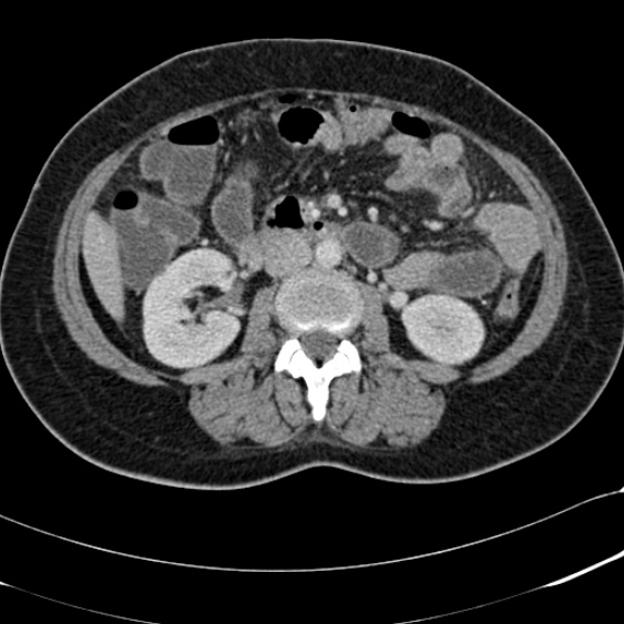 Acute appendicitis (Radiopaedia 48792-53822 Axial C+ portal venous phase 54).jpg
