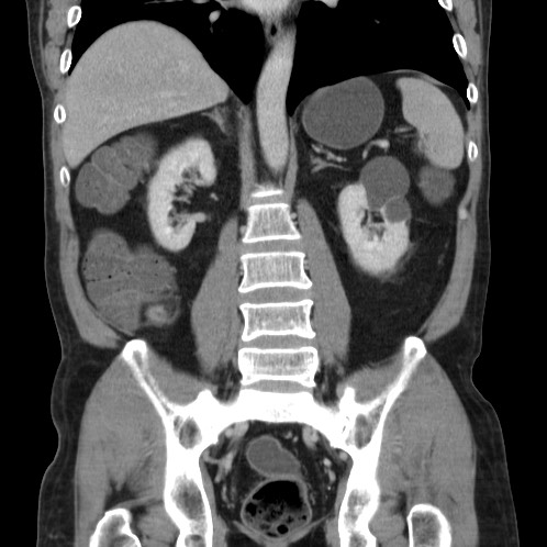 Acute appendicitis (Radiopaedia 66513-75790 Coronal C+ portal venous phase 55).jpg
