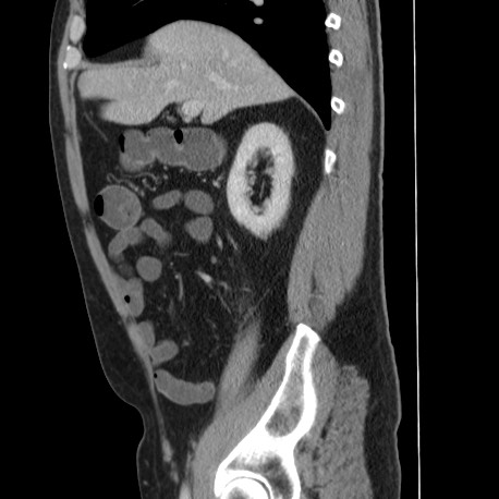 Acute appendicitis (Radiopaedia 66513-75790 Sagittal C+ portal venous phase 49).jpg