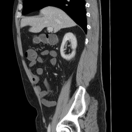Acute appendicitis (Radiopaedia 66513-75790 Sagittal C+ portal venous phase 51).jpg
