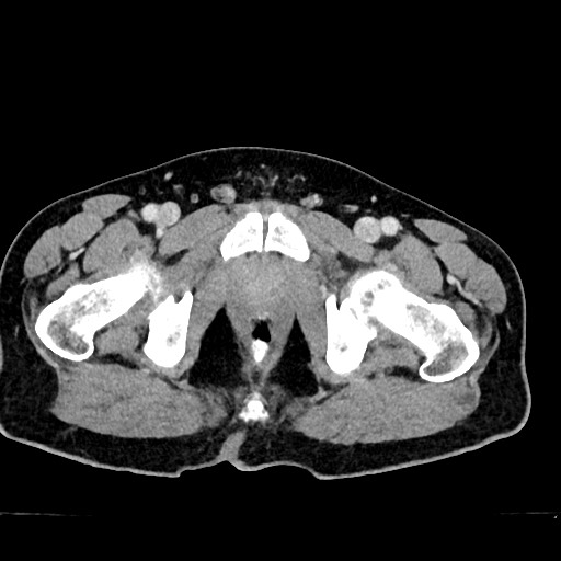 Acute appendicitis (Radiopaedia 77016-88960 Axial C+ portal venous phase 144).jpg