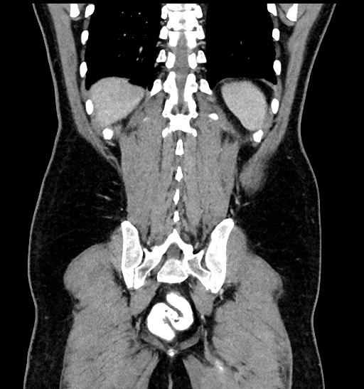 Acute appendicitis (Radiopaedia 77016-88960 Coronal C+ portal venous phase 79).jpg