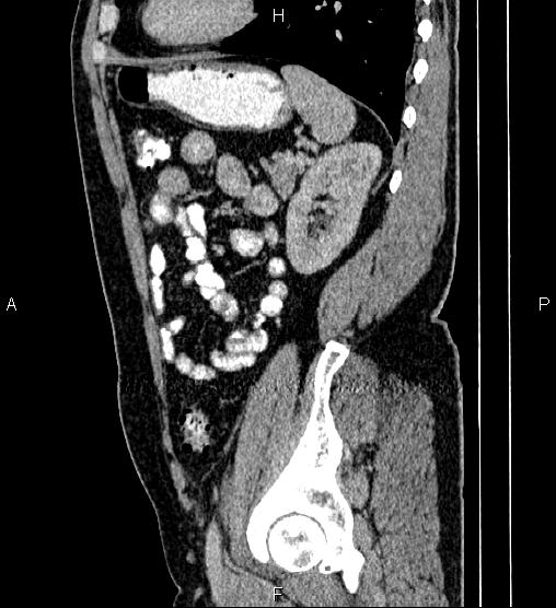 Acute appendicitis (Radiopaedia 84780-100240 Sagittal C+ portal venous phase 78).jpg