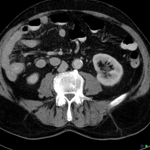 File:Acute appendicitis arising from a malrotated cecum (Radiopaedia 19970-19997 Axial C+ portal venous phase 18).jpg