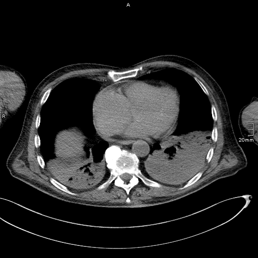 Acute aspiration pneumonitis (Radiopaedia 55642-62166 Axial liver window 44).jpg
