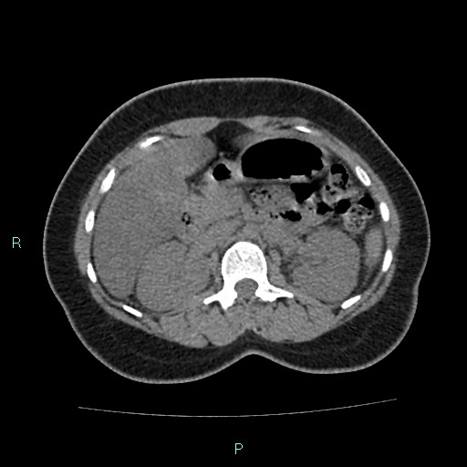 Acute bilateral pyelonephritis (Radiopaedia 37146-38881 Axial non-contrast 40).jpg