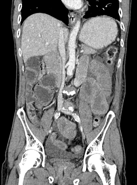 Acute bowel ischemia (Radiopaedia 87695-104114 Coronal C+ portal venous phase 213).jpg