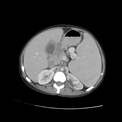 Acute calculous cholecystitis in patient with osteopetrosis (Radiopaedia 77871-90159 Axial C+ portal venous phase 36).jpg