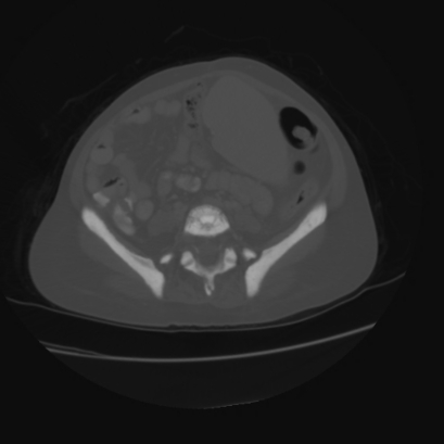 File:Acute calculous cholecystitis in patient with osteopetrosis (Radiopaedia 77871-90159 Axial bone window 34).jpg