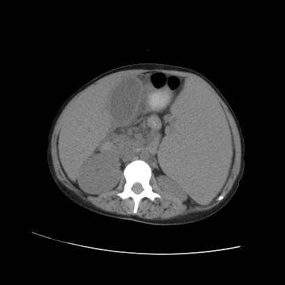 File:Acute calculous cholecystitis in patient with osteopetrosis (Radiopaedia 77871-90159 Axial non-contrast 40).jpg
