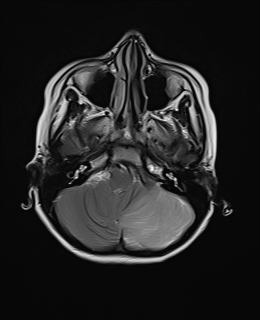 File:Acute cerebellar ataxia (Radiopaedia 61487-69446 Axial T2 4).jpg