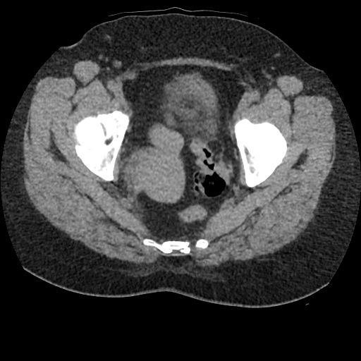 File:Acute cholecystitis and ureteric colic (Radiopaedia 42330-45444 Axial prone 99).jpg