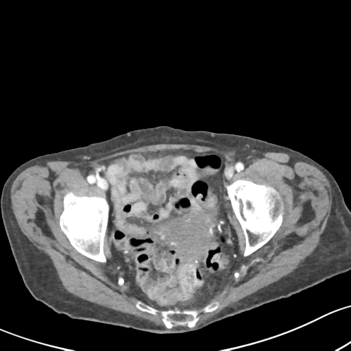 Acute cholecystitis with contained perforation (Radiopaedia 47328-51907 Axial C+ portal venous phase 65).png